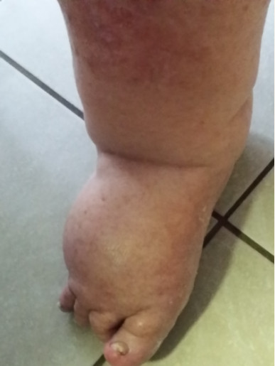 refloxology for adults